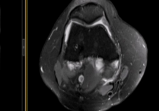 微創(chuàng)射頻消融術
